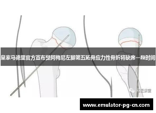 皇家马德里官方宣布楚阿梅尼左脚第五跖骨应力性骨折将缺席一段时间 皇家马德里官方宣布楚阿梅尼左脚第五跖骨应力性骨折将缺席一段时间